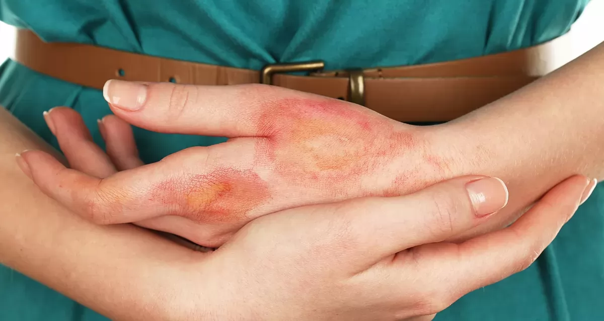 Что делать после ожога: лечение кожи и средства для заживления ран