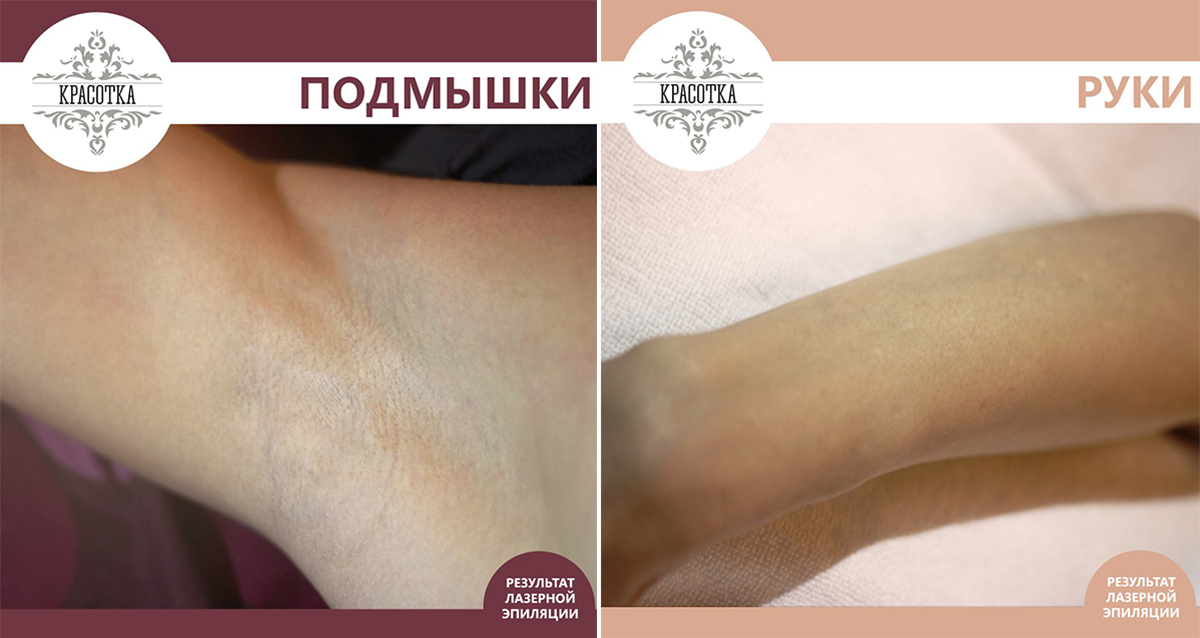 диодная лазерная эпиляция
