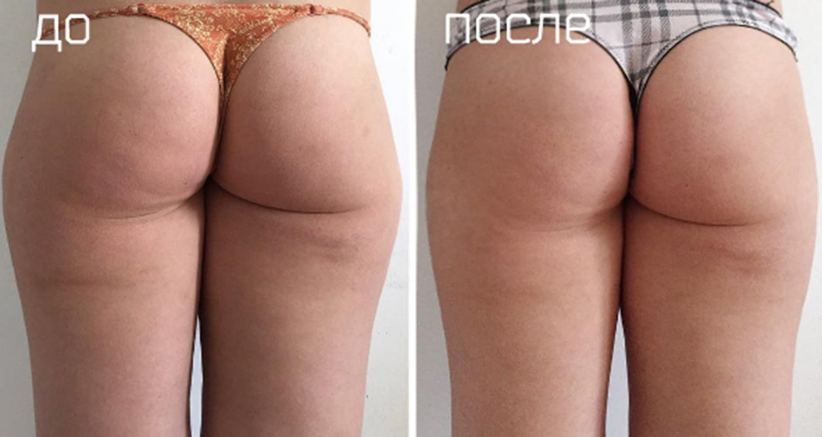 результат лпг массажа