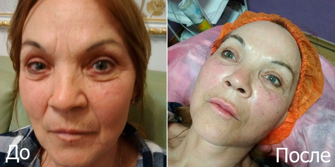 омоложение до и после